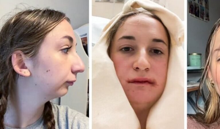 Young Woman Reveals Dramatic Results of Her Jaw Surgery, Leaving People Stunned Young Woman Reveals Dramatic Results of Her Jaw Surgery, Leaving People Stunned